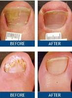 Laser Nail Therapy Clinic - Encino, CA image 3